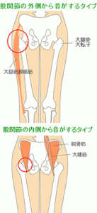 歩くと股関節がポキポキ鳴る 弾発股の治し方について 外来疼痛研究会
